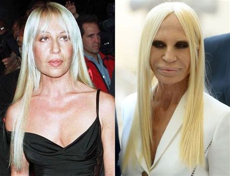 donatella versace before plastic surgury